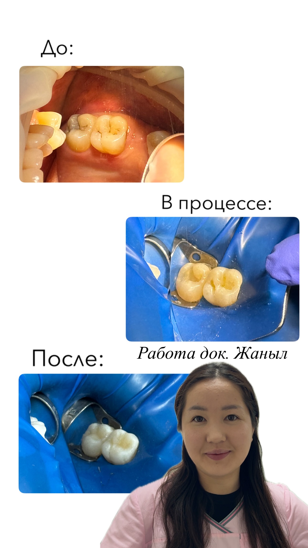 Лечение каналов зуба