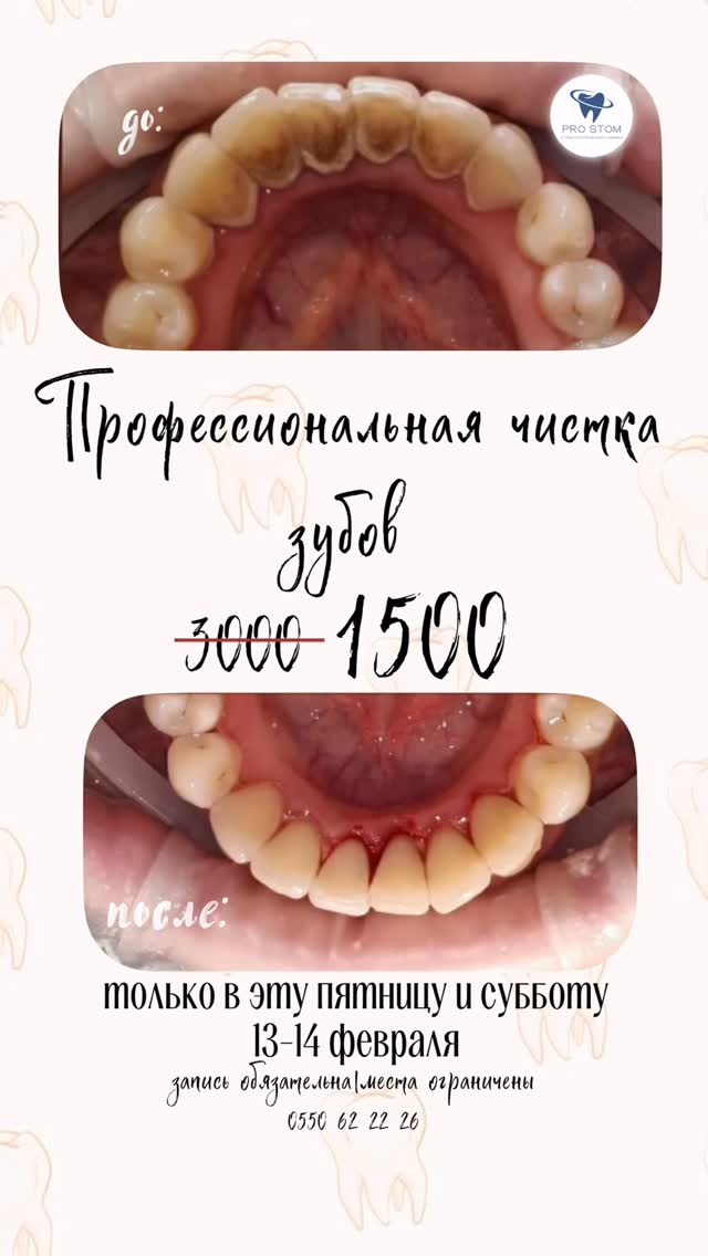 Профессиональная чистка зубов